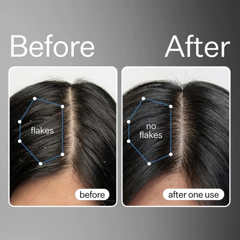 Act+Acre Cold Processed Vitamin E Scalp Detox Oil and BHA Salicylic Acid Scalp Exfoliator - For Dandruff and Dry Itchy Scalp - Hair Growth Treatment for Thinning Hair - Scalp Exfoliating Mask for Itch
