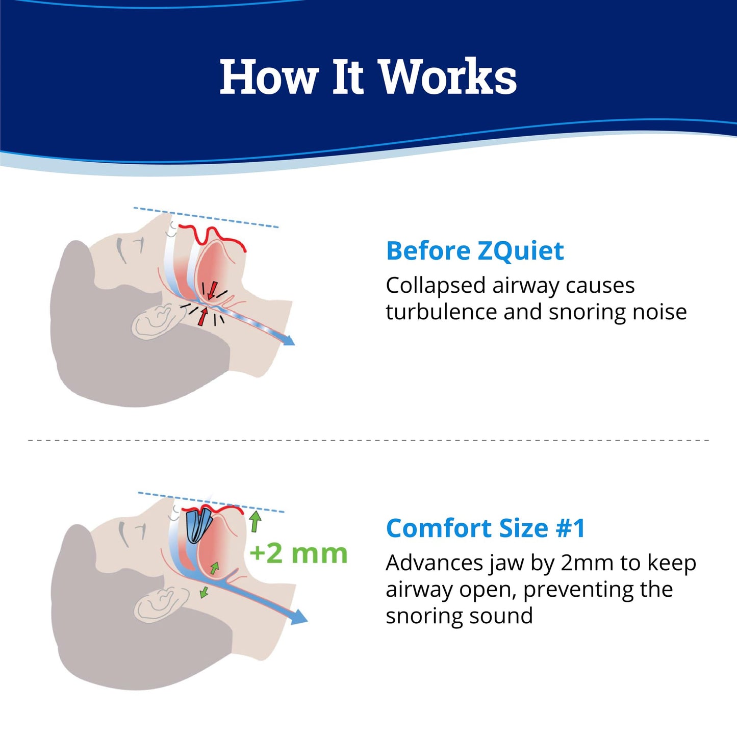 ZQuiet Anti-Snoring Mouthpiece Solution - Comfort Size #1 (Single Device) + Cleaner (1.5oz Bottle) - Made in USA Snoring Solution for a Better Night’s Sleep (Blue)