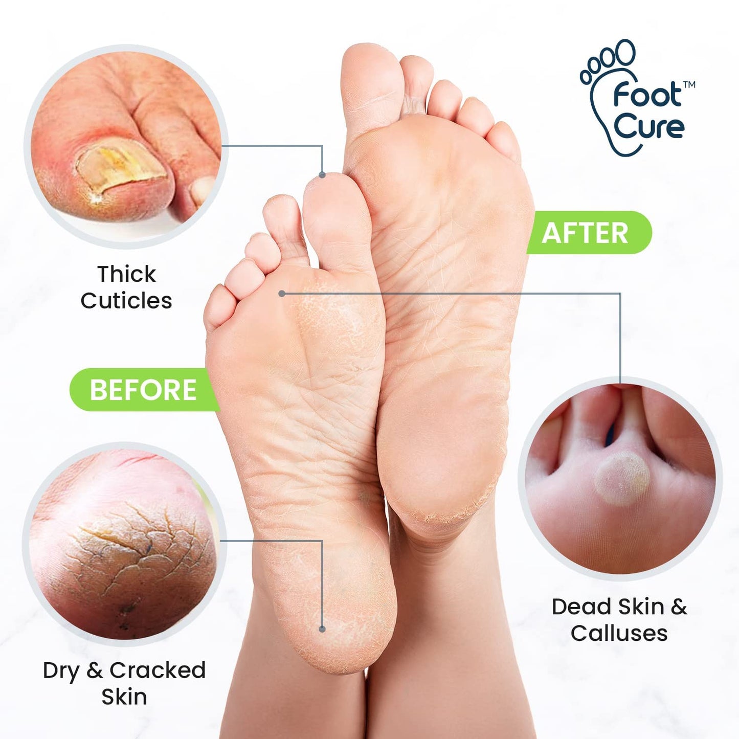 Foot Cure Foot Care/ Exfoliator & Callus Remover Pedicure Set – Includes Foot File for Dead Skin, Tea Tree Oil Foot Soak Salts, Urea Cream 40 Percent & Foot Callus Removal Gel – Made in USA