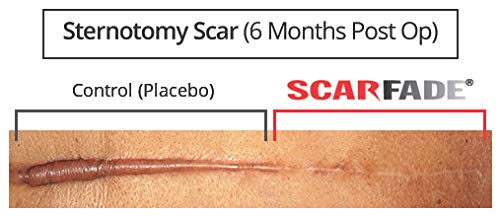Silicone Scar Ointment for Treatment of Surgery, Injury, Burn, Accident Scars, 2 Oz