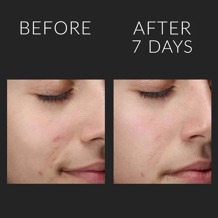 Kate Somerville Liquid ExfoliKate – Triple Acid Resurfacing Treatment – Clinically Formulated AHA Overnight Facial Exfoliator Smooths Skin and Minimizes Pores, 4 Fl Oz