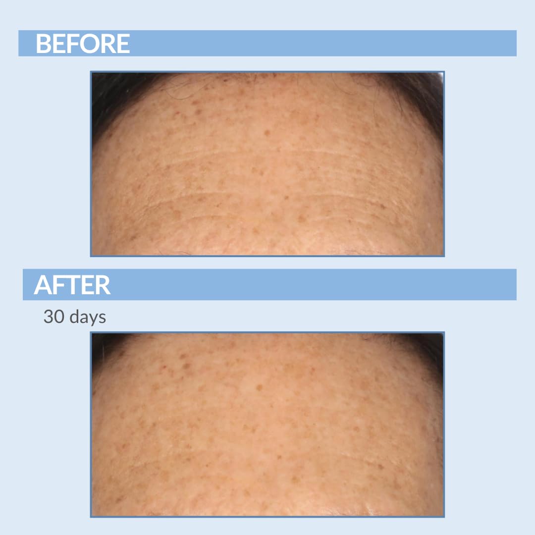 Vitamin A Force XR Retinol Serum Concentrate - Micro Exfoliate & Resurface for Radiant Skin - For Lines, Wrinkles - Pore Minimizer - Encapsulated Retinol for Anti-Aging - Serious Skincare - 1 Oz.