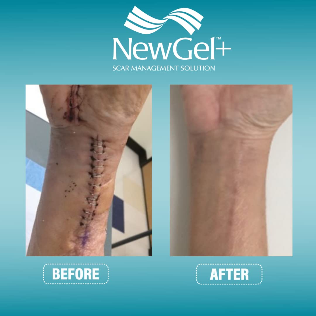 NewGel Advanced Silicone Professional Scar Treatment Tape by MyNewGel, Ultra-Thick, for Abdomen, C-Section, Keloids, Burns, Reusable, 2" x 24" Strip - Beige