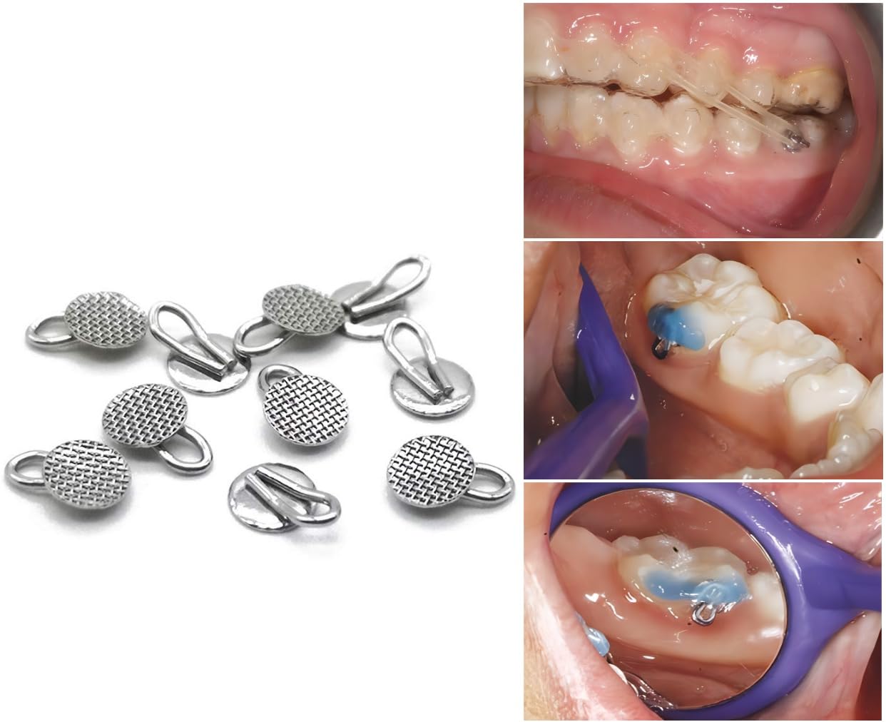 Dental Orthodontic Braces Bondable Lingual Buttons With Traction Hooks,10pcs/Pack, Mesh Base (5 Packs)