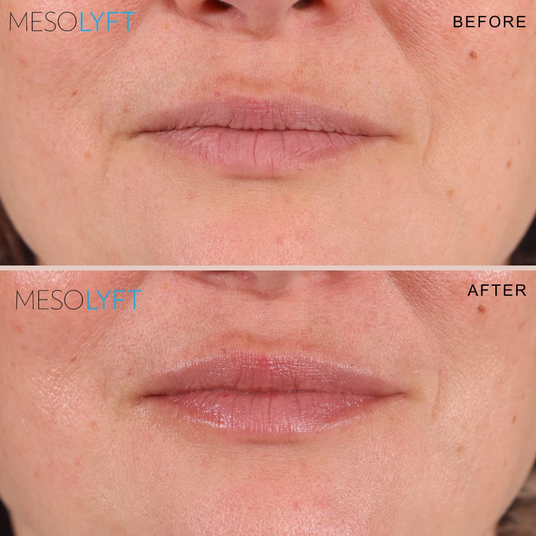 MESOLYFT Lip Plumper with Roller to Instantly Plump Lips, Promotes Hydration and Fullness, Plumping Lip Gloss for Fuller Lips, Serum to Moisturize Your Lips (12 ML)