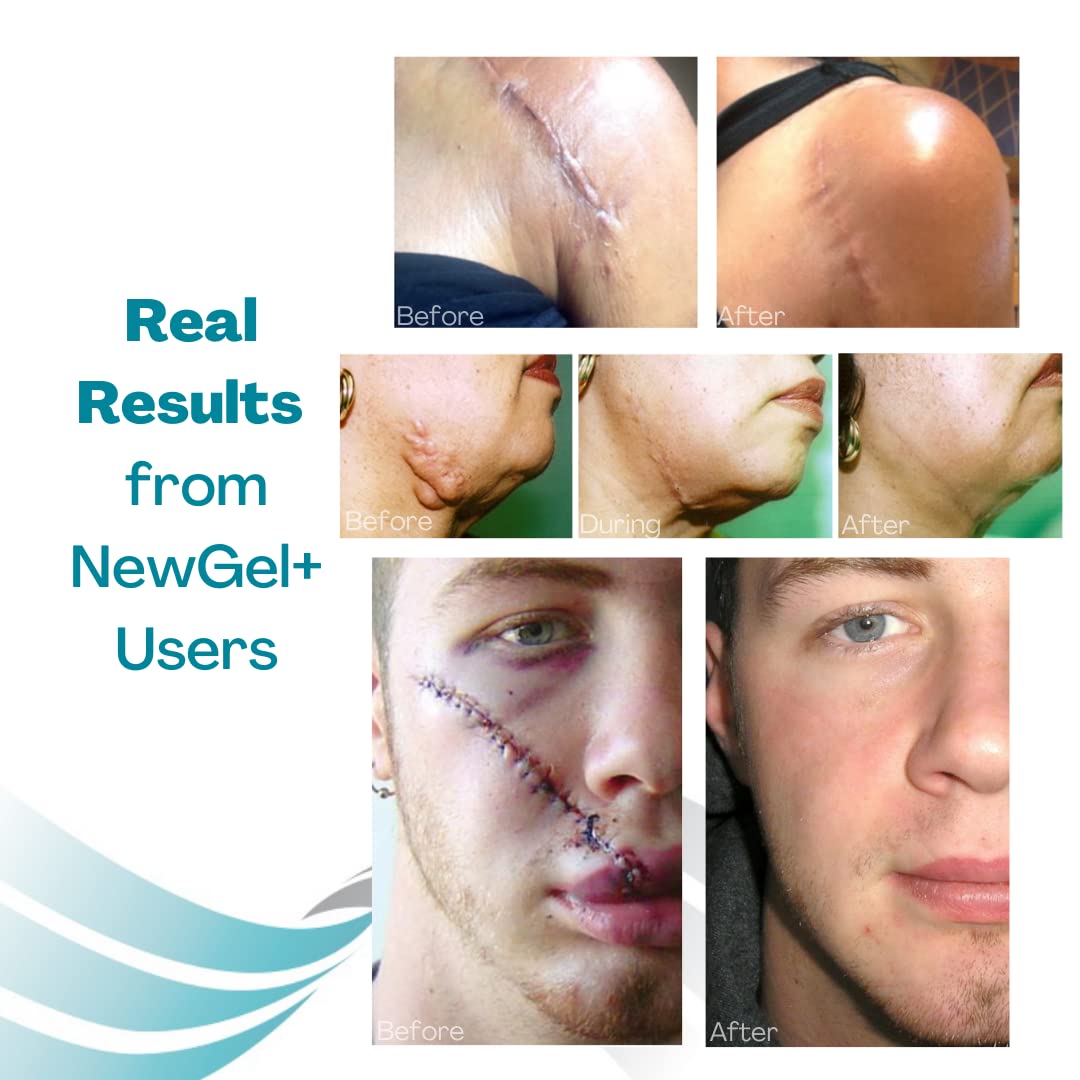 NewGel Advanced Silicone Professional Scar Treatment Tape by MyNewGel, Ultra-Thick, for Abdomen, C-Section, Keloids, Burns, Reusable, 2" x 24" Strip - Beige