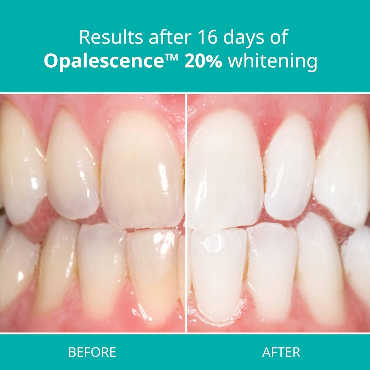 Opalescence 20% with PF Whitening Whitening Refill Kit (4 Packs / 8 Syringes) Carbamide Peroxide. Made by Ultradent, in Melon Flavor. Tooth Whitening Refill Syringes - B-5401-4