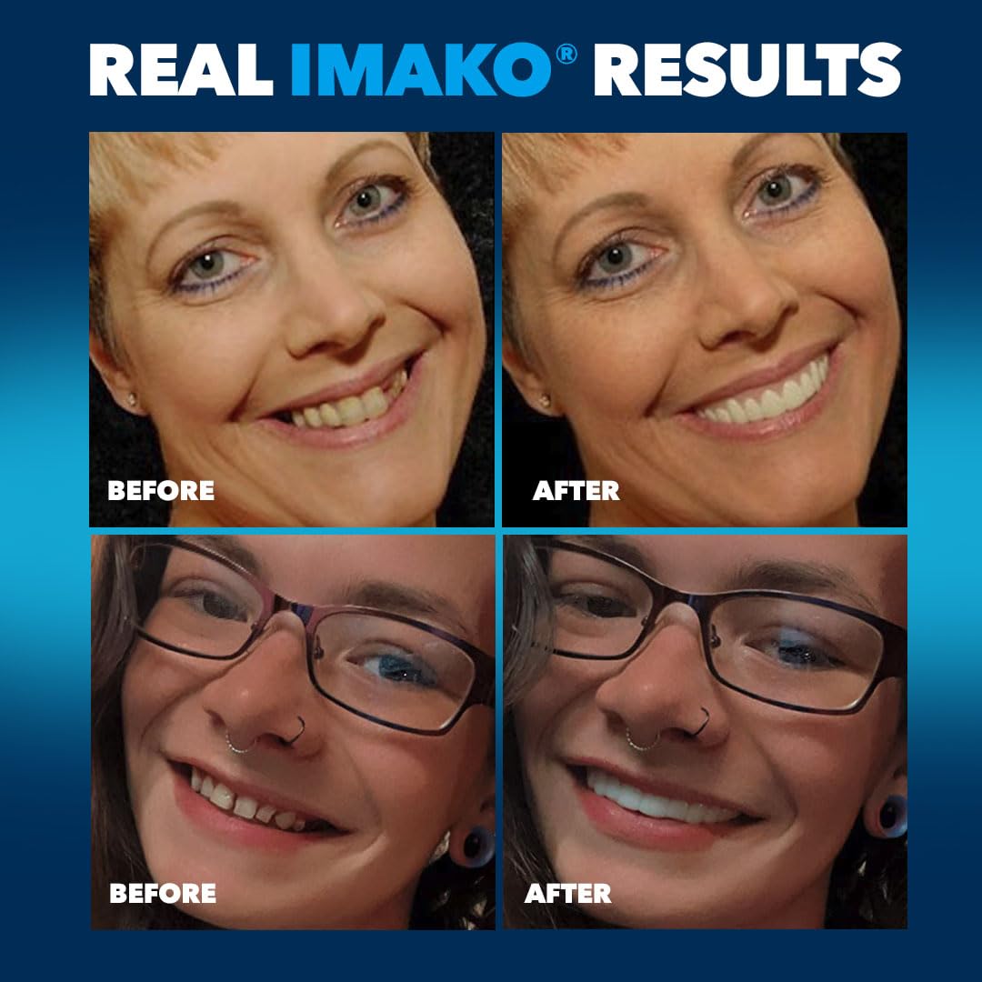 Imako Premium Cosmetic Uppers - 2 Pack - Small, Natural White - DIY Smile Makeover - Made in USA