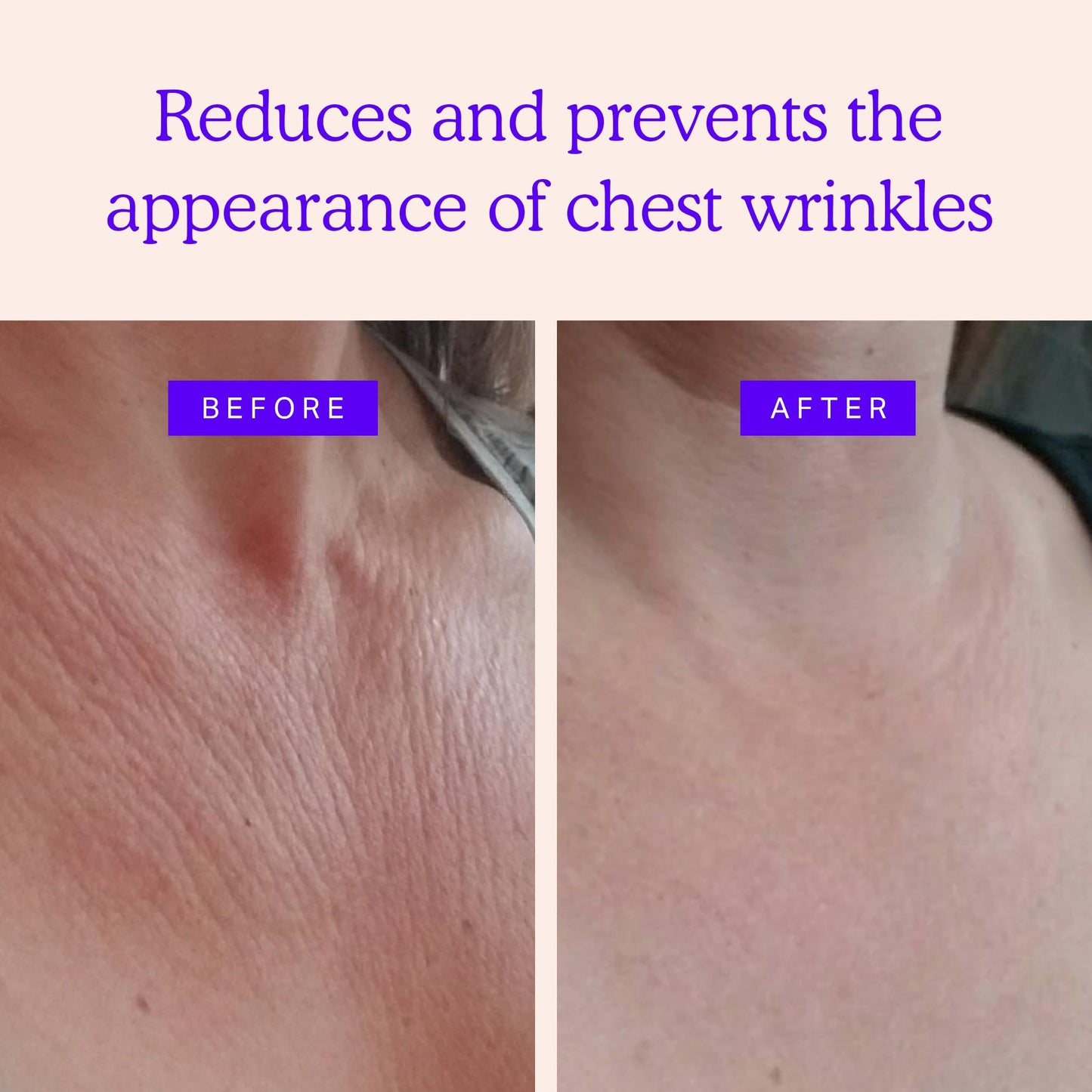 BLUMBODY Chest Wrinkle Pads – Anti-Wrinkle Silicone Patches Skin Firming & Smoothing – Reusable Overnight Chest Pads – Anti-Aging Crepe Erase Pads – Neck & Décolleté (2-Month Supply)
