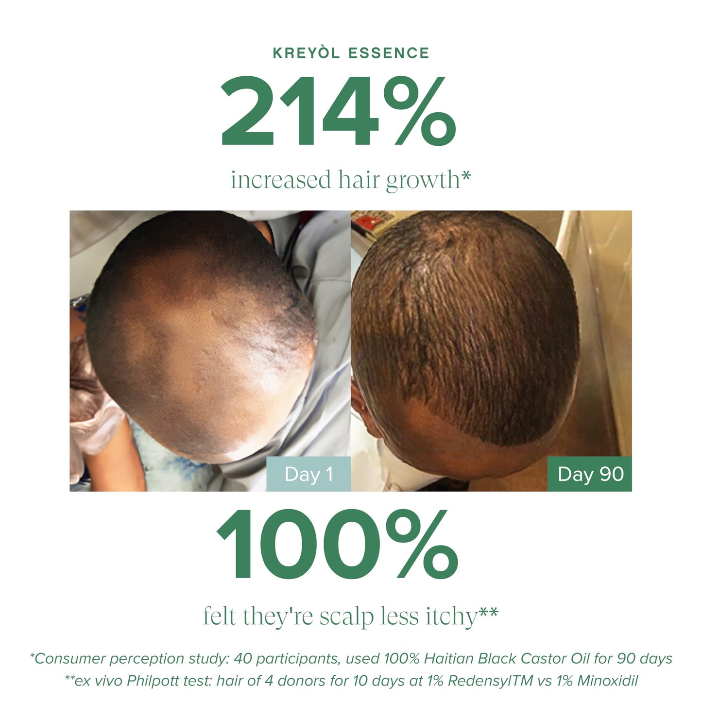 Kreyol Essence - Save Our Scalp Serum (S.O.S Serum) - Redensyl + Haitian Black Castor oil, Fuller Looking Hair, Cold Pressed Castor Oil, Natural Ingredients 1.7 oz