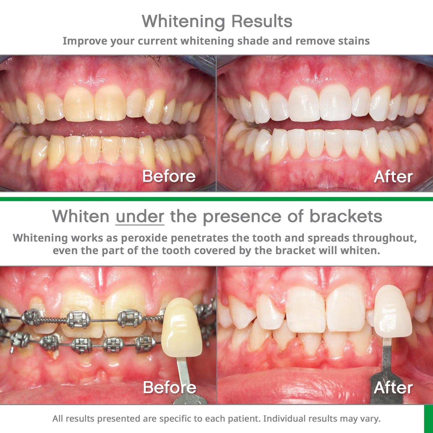 Opalescence Go 10% - Prefilled Teeth Whitening Trays Kit (10 Treatments) - 10% Hydrogen Peroxide - Mint Made by Ultradent Products. Go Teeth Whitening Kit -Mint- GO10-5193-1