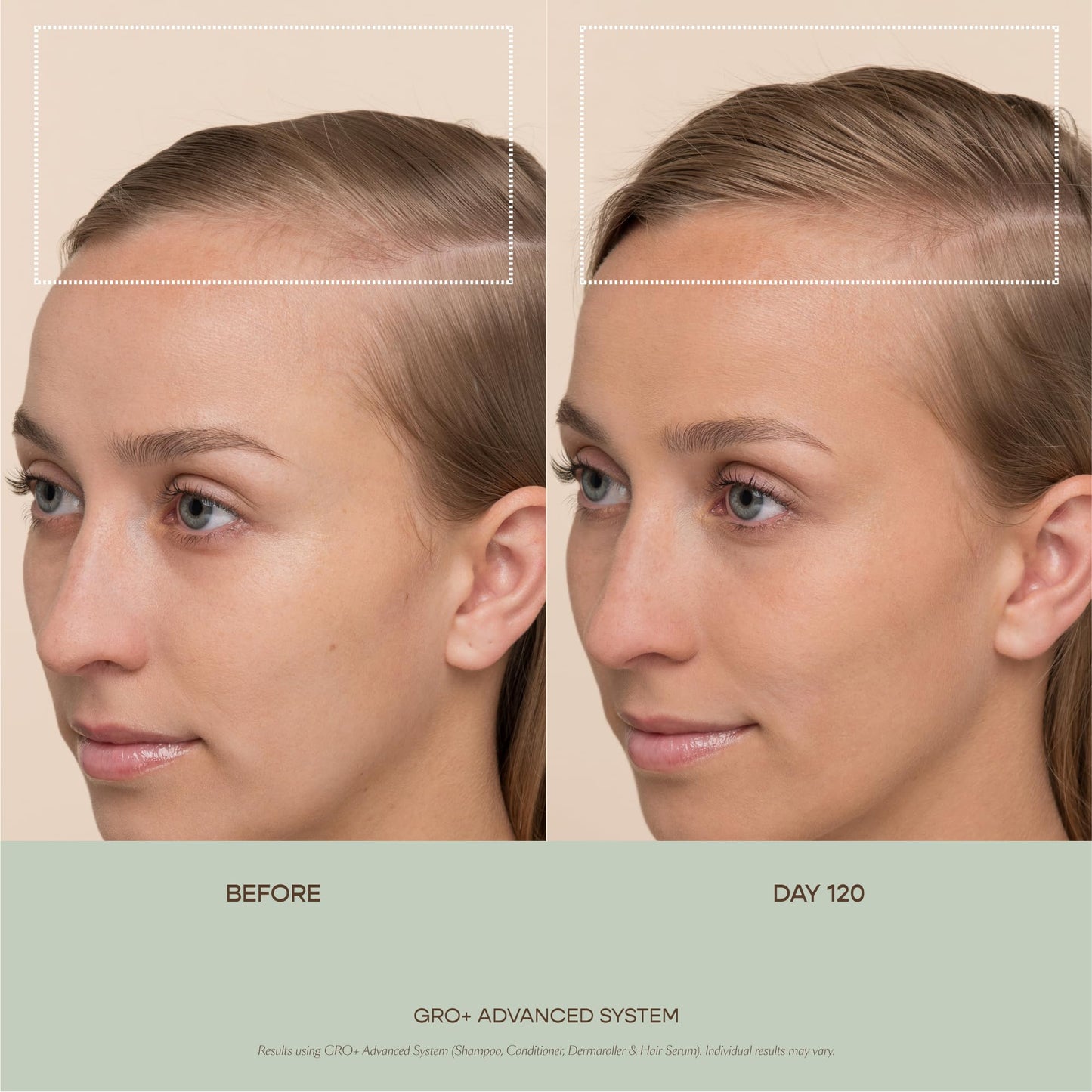 VEGAMOUR GRO+ Advanced Hair Serum for Improving Hair Density, Reduces Shedding and Promotes a Healthy Scalp, 1 pack