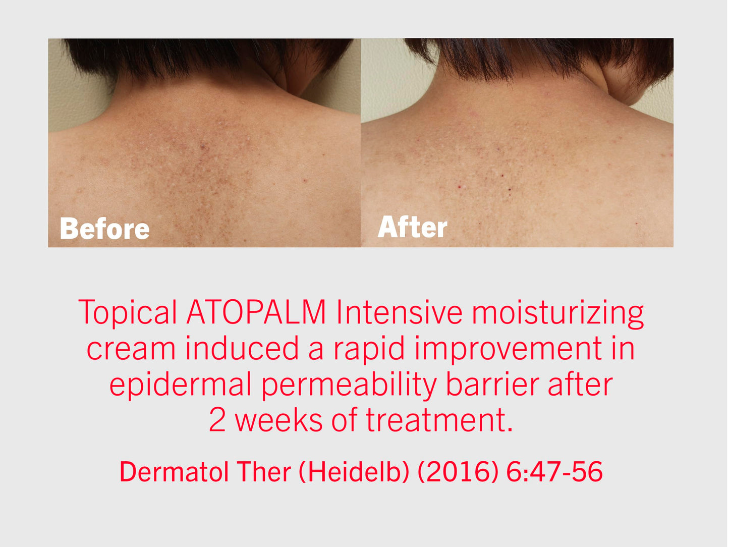 ATOPALM | Intensive Moisturizing Cream | Face & Body Moisturizer | For Dry & Sensitive Skin | Paraben-Free Lotion | Replenishes Hydration | Skin Barrier Repair | Korean Skin Care | 3.4 fl oz (100ml)