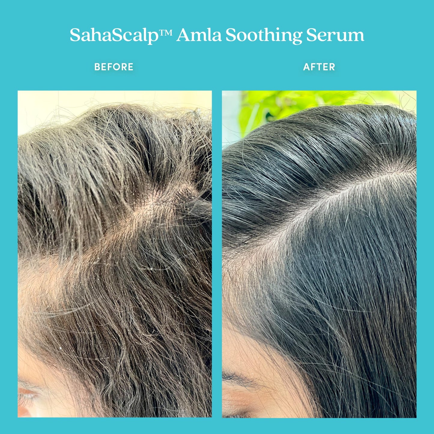 Fable & Mane SahaScalp Soothing Scalp Serum with Amla Oil & Rosemary Oil for Hair, Itchy Scalp Treatment, Scalp Oil for use with Scalp Massager - Genuine Fable and Mane Hair Oil, 1.8FL oz